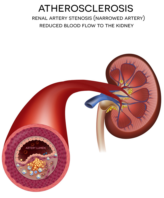 End-Stage Renal Disease