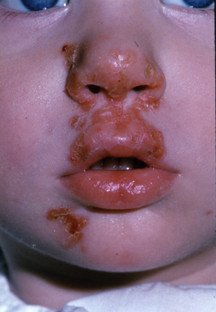 impetigo in children face