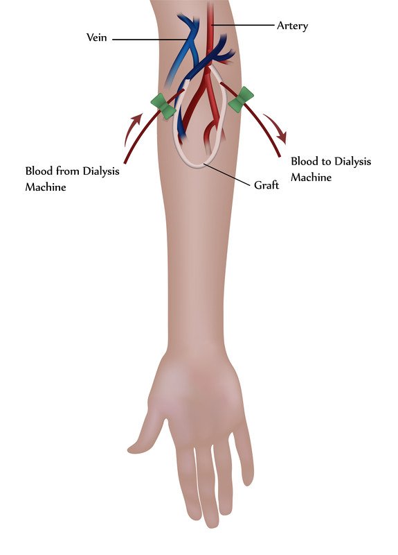 Kidney failure