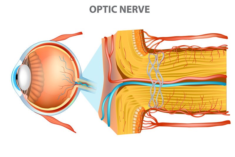 Optic nerve swelling (papilledema)