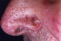 Basal cell carcinoma