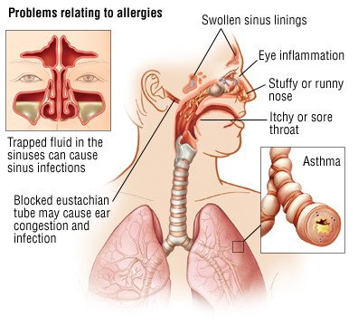 Relief For Out Of Control Allergy Symptoms