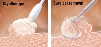 Jóindulatú papilloma ugola, Hpv lezeres eltavolitas