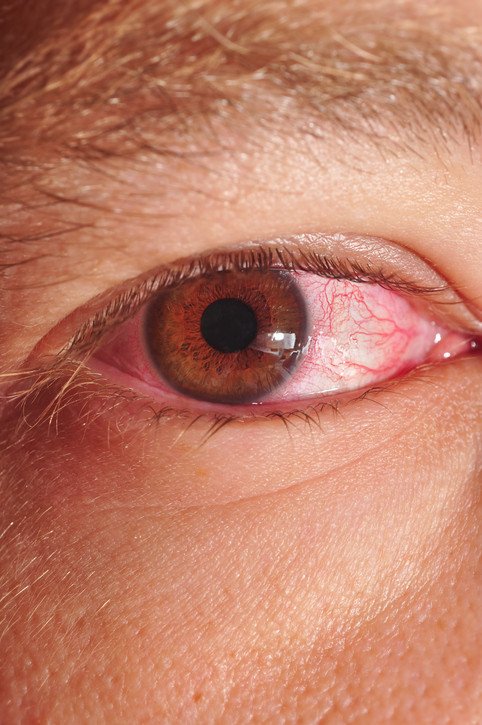 Pink eye (conjunctivitis)