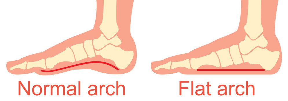 Foot Pain in the arch - Foot Problems