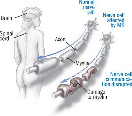 Multiple Sclerosis