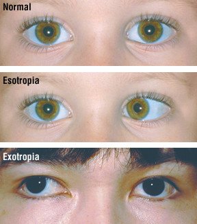 Crossed Eyes (Strabismus) Guide: Causes, Symptoms and Treatment