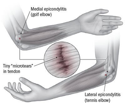 Tennis elbow (lateral epicondylitis)