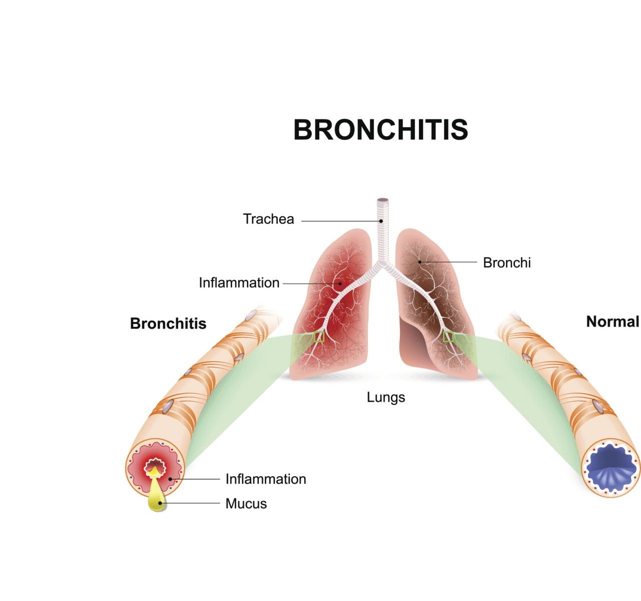 Acute bronchitis