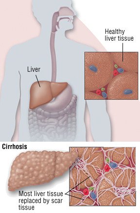 Hepatitis C