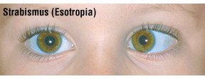 Double vision (diplopia)