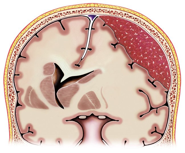 Subdural hematoma