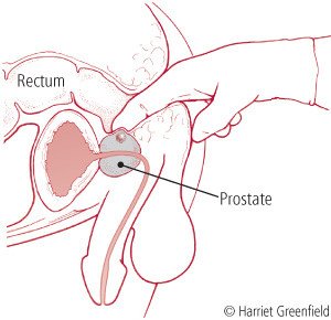 prostatitis rectum
