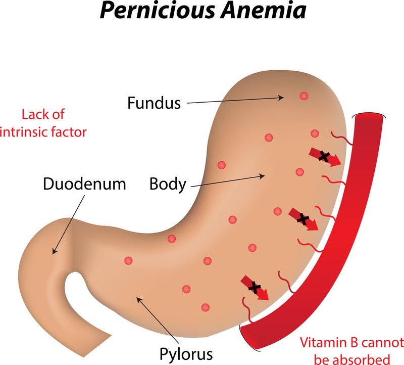 cykel Kirken Blot Vitamin B12 deficiency Guide: Causes, Symptoms and Treatment Options