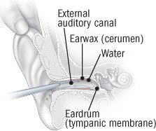 Wax blockage of the ear canal