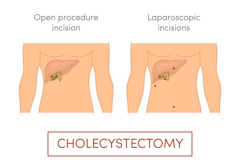 Cholecystectomy