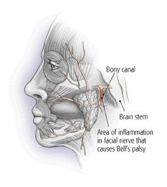 Bell's Palsy