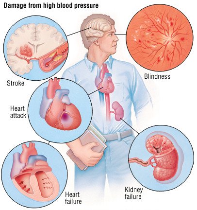 can high blood pressure cause heart attack