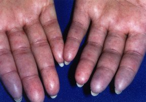 Scleroderma