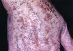 Age spots (solar lentigo, liver spots)