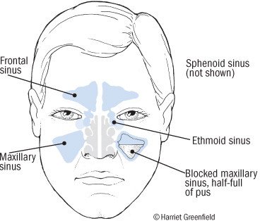 Acute Sinusitis Guide Causes Symptoms And Treatment Options Acute Sinusitis Guide Causes Symptoms And Treatment Options
