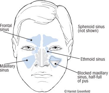 Maxillary sinus disease: diagnosis and treatment