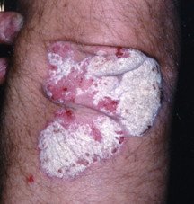 Psoriasis