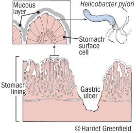 Gastritis