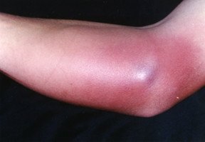 MRSA Skin Infection