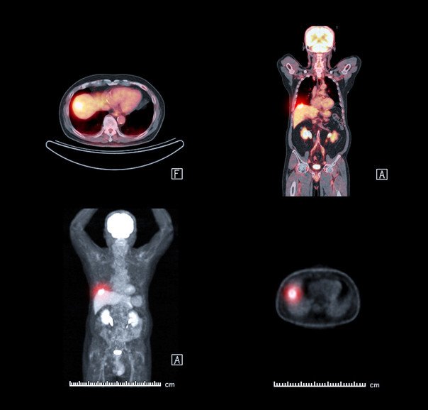 Radionuclide Scanning