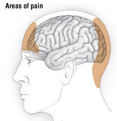 Tension headache