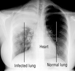 Pneumonia