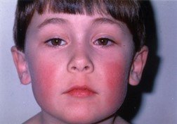 Fifth Disease (Erythema Infectiosum)