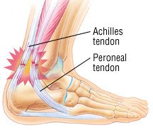 pain outside of achilles tendon