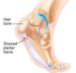 sudden heel pain