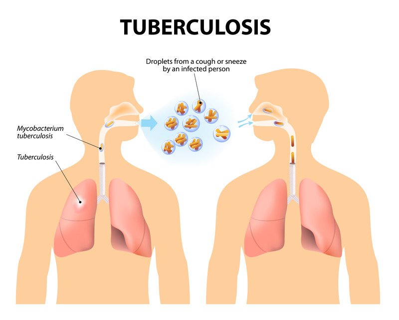 Mapa Mental De Tuberculosis Tuberculosis Hemoptisis O