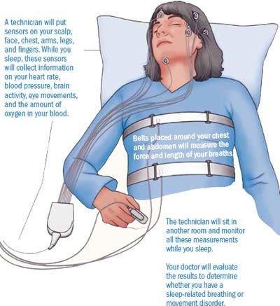 Sleep apnea