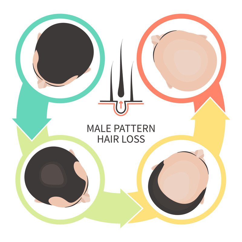 Hair Loss Guide: Causes, Symptoms and Treatment Options