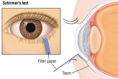 Dry eye syndrome