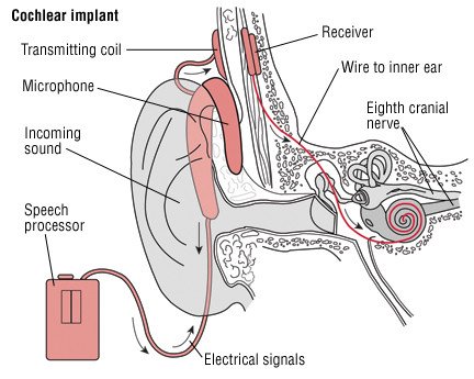 Hearing Loss in Children