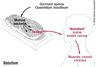 Botulism