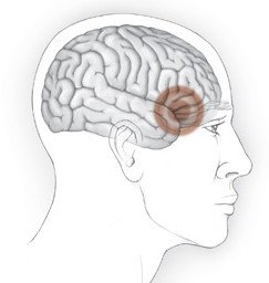 Cluster headache