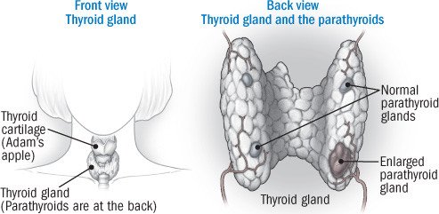 Hypoparathyroidism