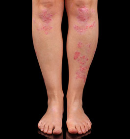 Guttate psoriasis az arcomon | Sanidex Magyarországon