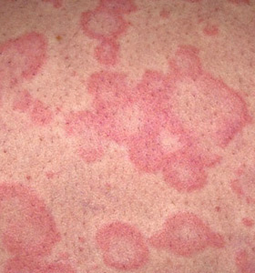What Are Hives Urticaria Investigating This Bizarre Skin Condition