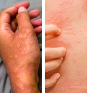 What Are Hives Urticaria Investigating This Bizarre Skin Condition
