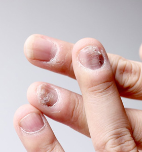 Psoriatic Arthritis: Symptoms, Causes and Treatments Psoriatic Arthritis: Symptoms, Causes and Treatments