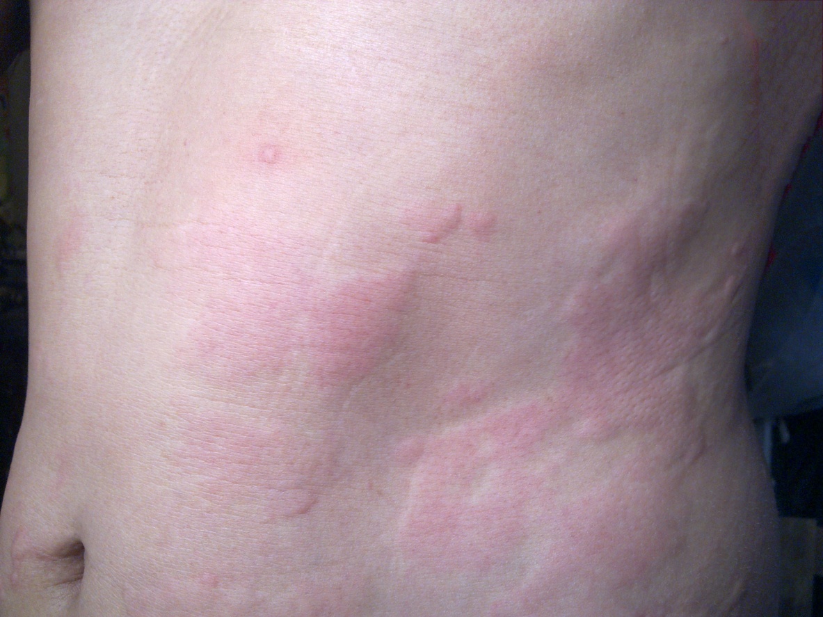 gabapentin and hives