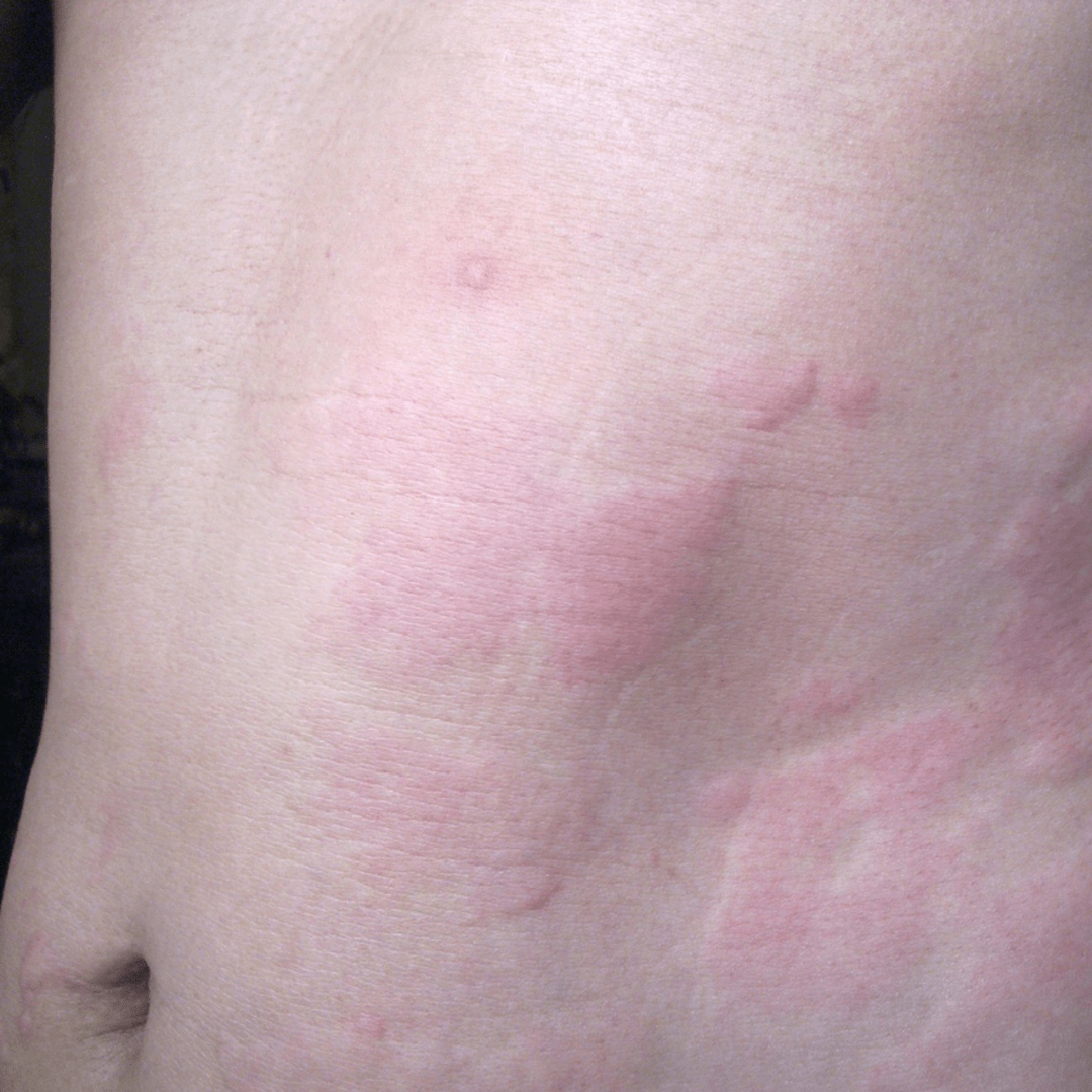 Large circular thigh rash