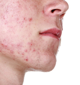 Acne (Acne vulgaris)